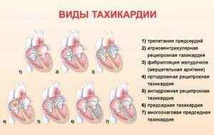Тахикардия сердца: симптомы, диагностика и лечение - DELFI