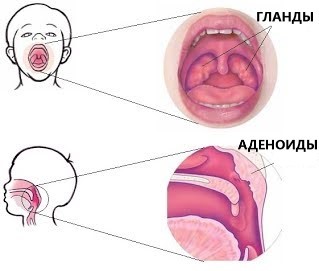 Аденоиды у детей клинические симптомы и лечение