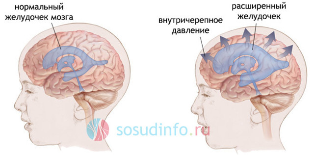 Гипертензионный синдром у детей и взрослых: симптомы, лечение