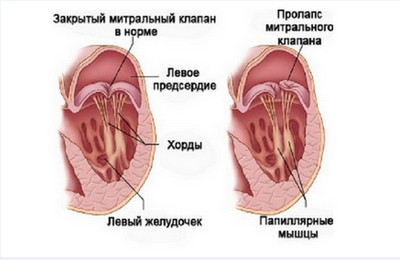 Пролапс митрального клапана с регургитацией 2 степени
