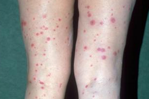 Васкулит мозга