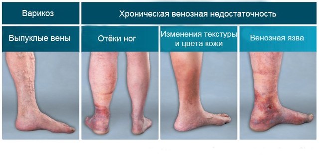 Троксевазин при геморрое: инструкция по применению