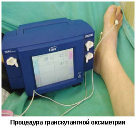 Отекают ноги при сахарном диабете - что делать?