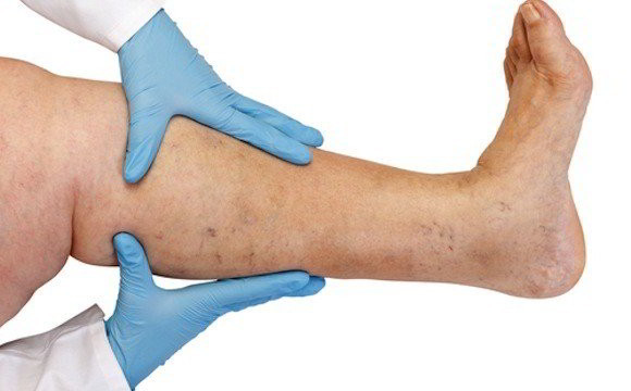 Тромб в ноге – причины, симптомы и лечение