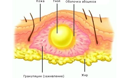 Абсцесс после укола: симптомы и лечение. Абсцесс ягодицы после укола: лечение, фото, симптомы.