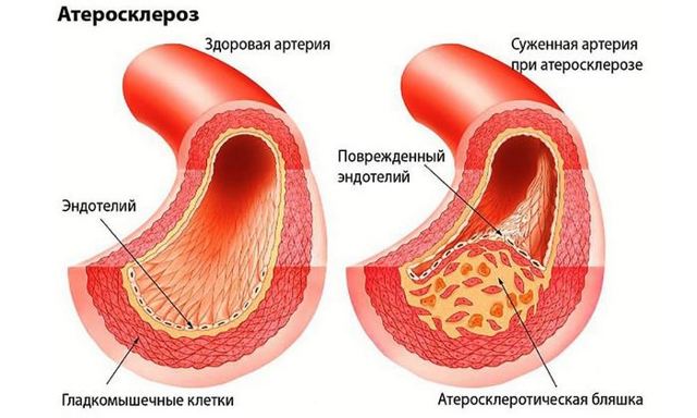 Какая норма холестерина в крови у женщин и мужчин по возрасту