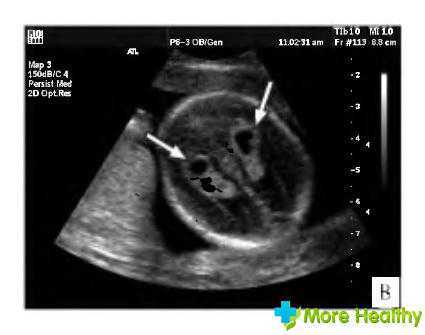 Киста сосудистого сплетения головного мозга: возникновение, диагностика, лечение. Опасна ли киста сосудистого сплетения для новорожденного?