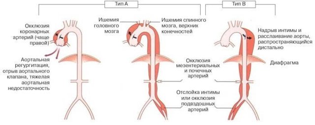 Расслоение аорты — Симптом Инфо