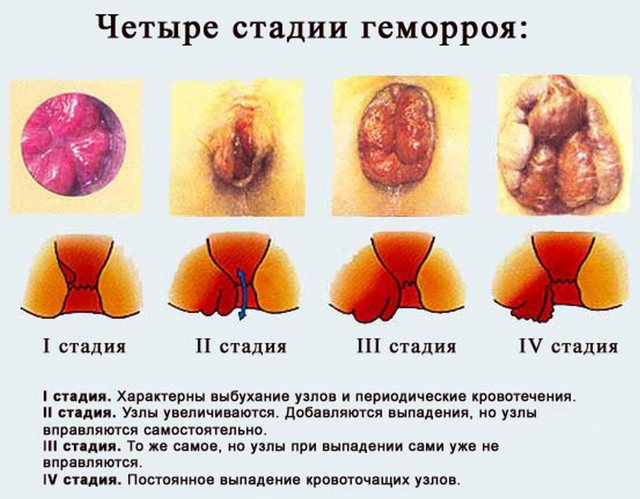 Троксерутин при геморрое: отзывы пациентов и инструкция по применению