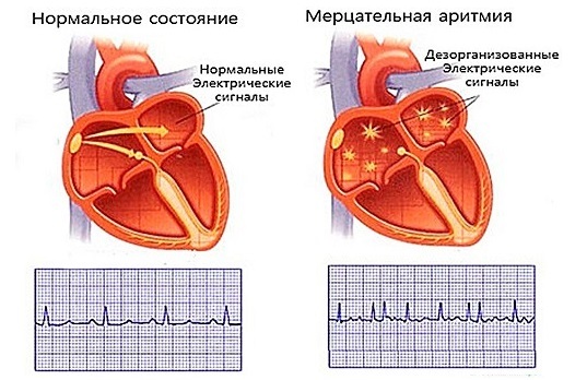 Скорая помощь при аритмии