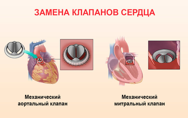 Инвалидность при ИБС - советы адвокатов и юристов
