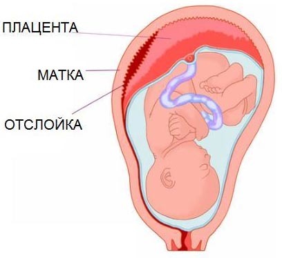 Нарушение плацентарное - причины появления симптома, способы лечения
