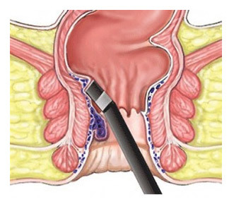 Удаление геморроя - операция лазером и другие методы хирургического лечения, цена и отзывы