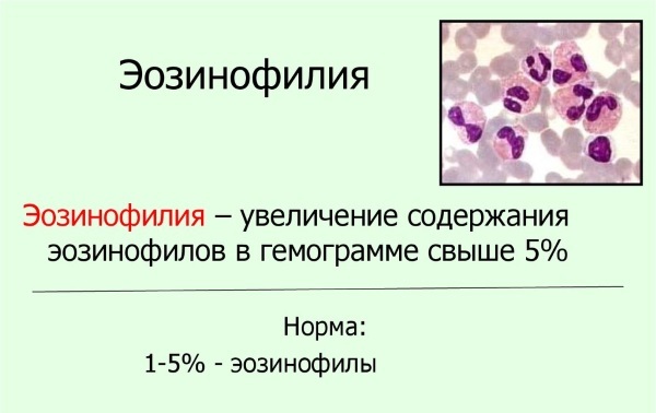 Эозинофилы повышены: патология или вариант нормы