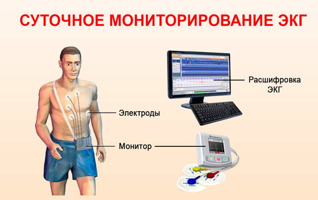 Желудочковые экстрасистолы норма