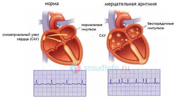 Радиочастотная абляция сердца (РЧА): что это такое, показания и противопоказания, реабилитация после операции