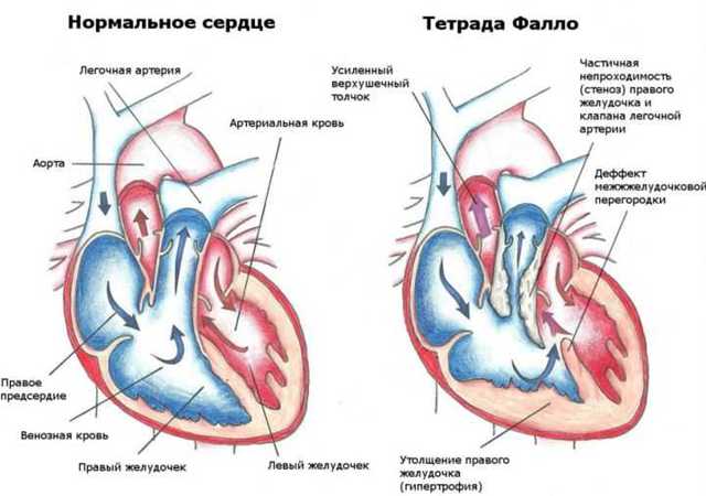 ЭКГ. Гипертрофия правого желудочка. Характерные признаки гипертрофии правого желудочка на ЭКГ
