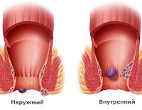 Первая стадия геморроя: лечение, причины, симптомы