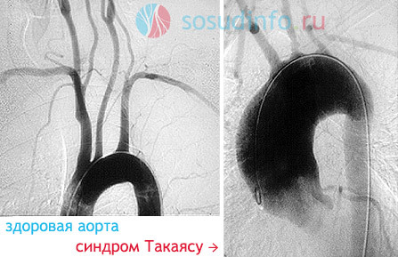 Артериит Такаясу — обследование, диагноз
