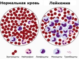 Низкие тромбоциты при беременности: пониженный уровень от нормы, как снизить