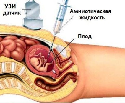 Киста сосудистого сплетения головного мозга: возникновение, диагностика, лечение. Опасна ли киста сосудистого сплетения для новорожденного?