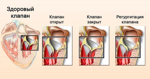 Пролапс митрального клапана – что это, чем опасен?