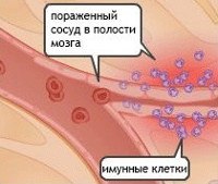 Васкулит мозга