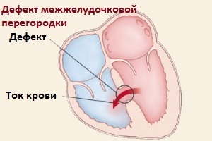 Врожденный порок сердца у новорожденных детей: что это, причины, последствия, классификация и лечение