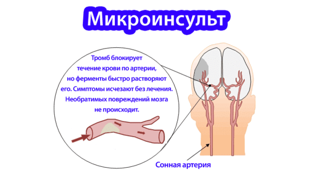 Микроинсульт – симптомы и последствия, признаки, лечение, или Берегите здоровье смолоду