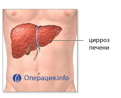 Пересадка печени: виды, выбор донора, ход процедуры.