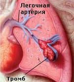Тромбоэмболия легочной артерии: симптомы и лечение