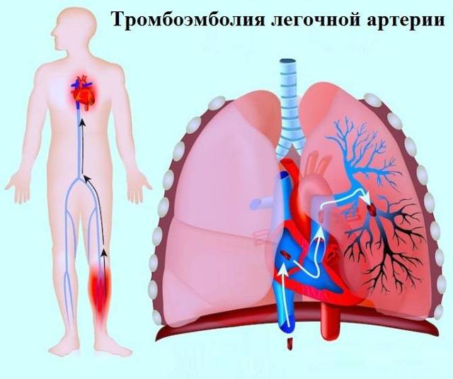 Тромбоэмболия: виды, причины, симптомы артериальной и венозной, лечение