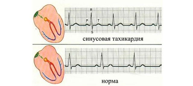 Берут ли в армию с тахикардией в 2019 году?