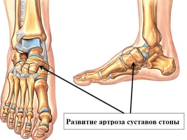 Болит пятка, больно наступать: как лечить, почему болит
