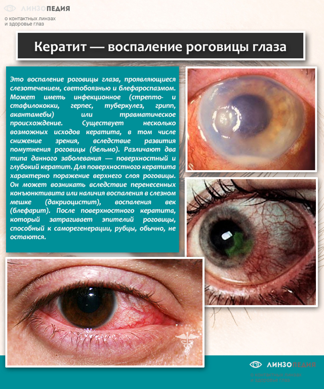Сульфацил натрия – капли глазные: описание, состав, инструкция