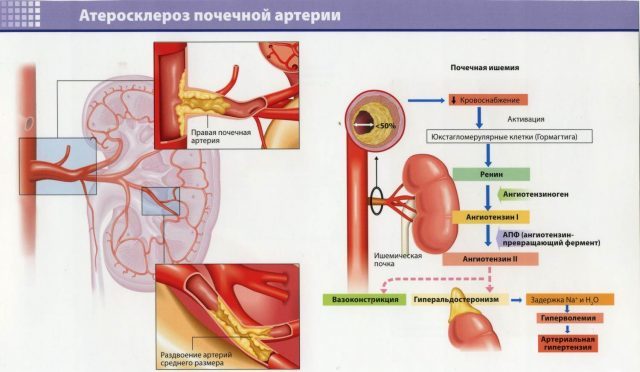Тромбоз почечной вены причины, симптомы, лечение