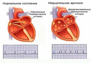 Обезболивающие при атеросклерозе сосудов нижних конечностей