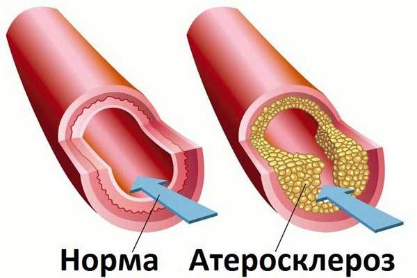Укрепление сосудов - препараты для укрепления сосудов и капилляров