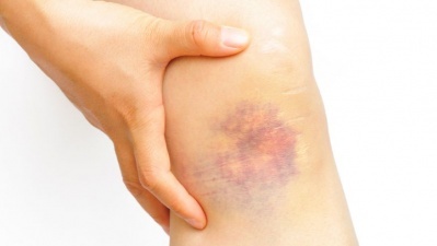 Послеоперационный период при операции на венах ног