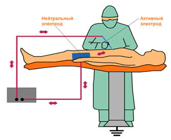 Электрохирургический коагулятор (ЭХВЧ-аппарат): обзор, основные функции и назначение