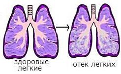 Высокое давление тахикардия - Лечение гипертонии