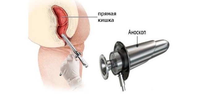 Тромбоз наружного геморроидального узла: причины и лечение