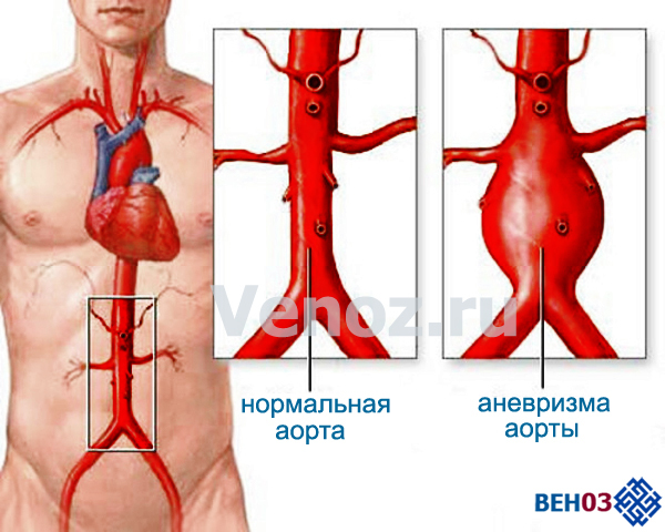 Лечение сосудов: как лечить болезни и заболевания сосудов и вен