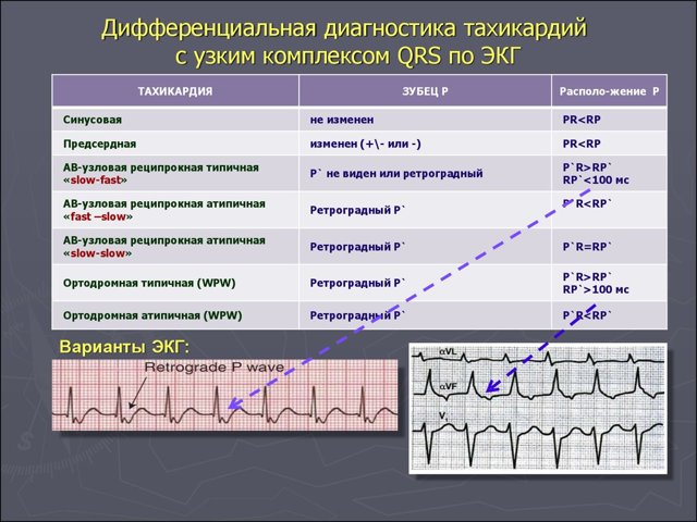 Берут ли в армию с тахикардией в 2019 году?