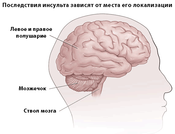 Последствия инсульта у мужчин и методы их реабилитации