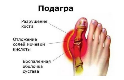 Мочевая кислота составляет уменя 755 что делать. Какая норма мочевой кислоты в крови мужчин, женщин и детей