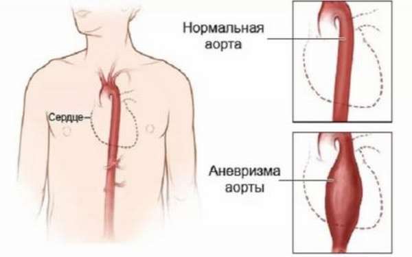 Расширение восходящего отдела аорты сердца