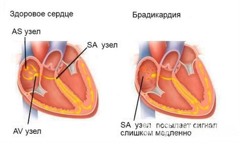 Брадикардия сердца: что это такое и как лечить, симптомы, причины