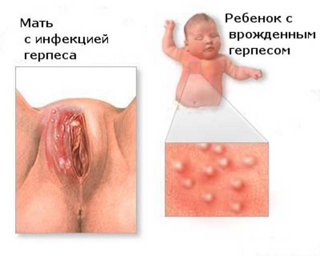 Генитальный герпес у женщин — Витагерпавак