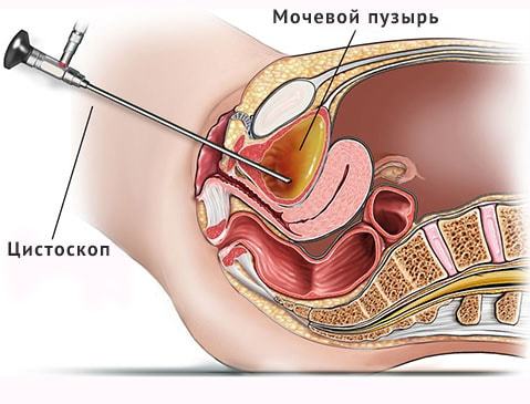 Причины, признаки и лечение олигурии
